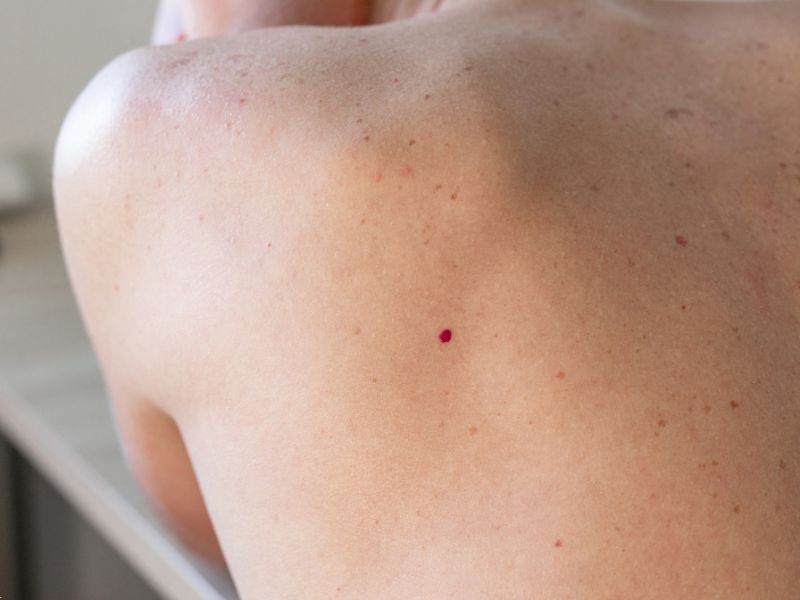 נקודות חן אדומות